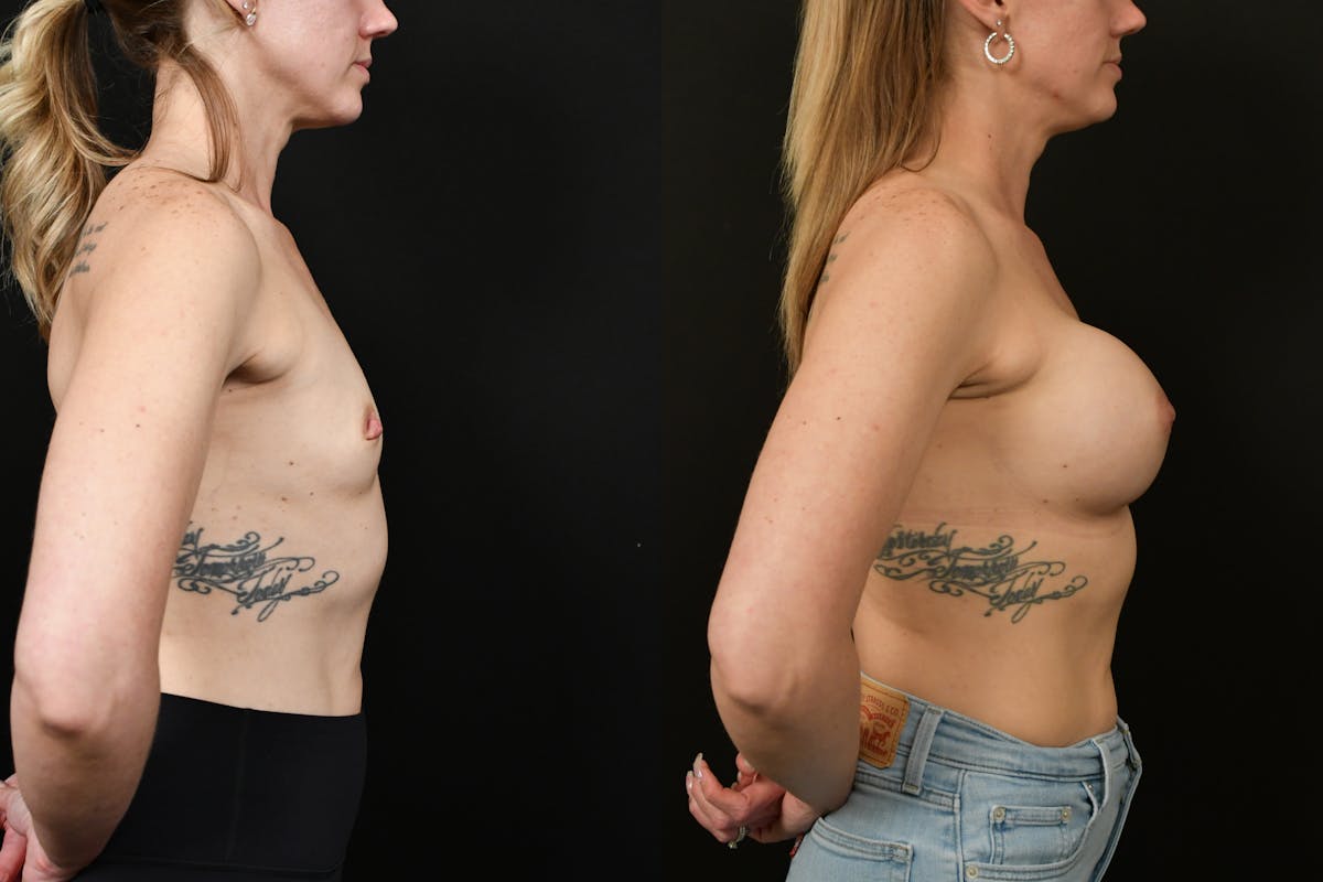 Breast Augmentation Before & After Gallery - Patient 217157 - Image 4