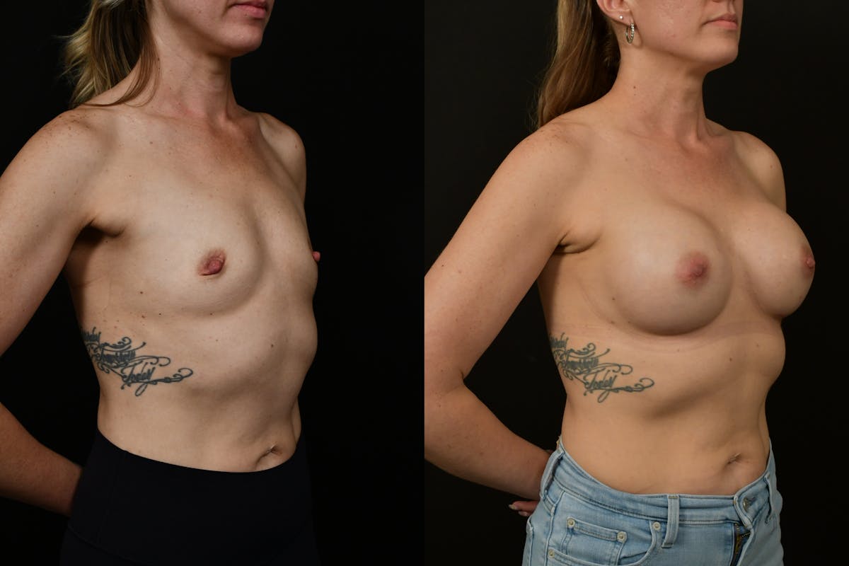 Breast Augmentation Before & After Gallery - Patient 217157 - Image 3