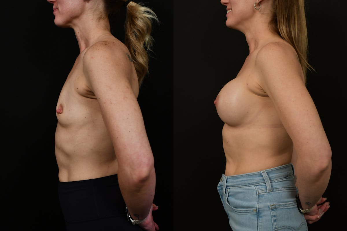 Breast Augmentation Before & After Gallery - Patient 217157 - Image 6