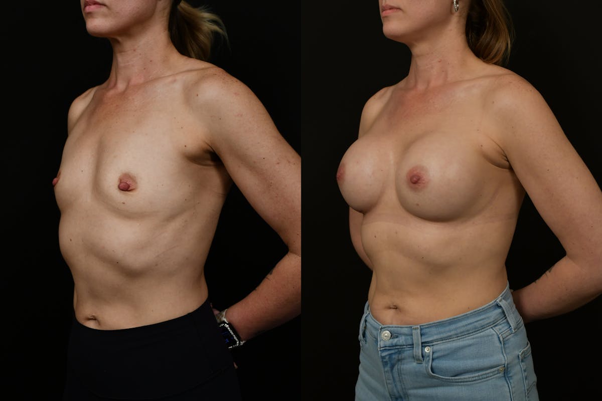 Breast Augmentation Before & After Gallery - Patient 217157 - Image 5
