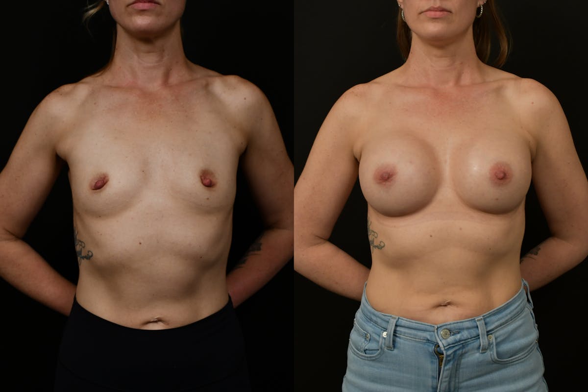 Breast Augmentation Before & After Gallery - Patient 217157 - Image 1