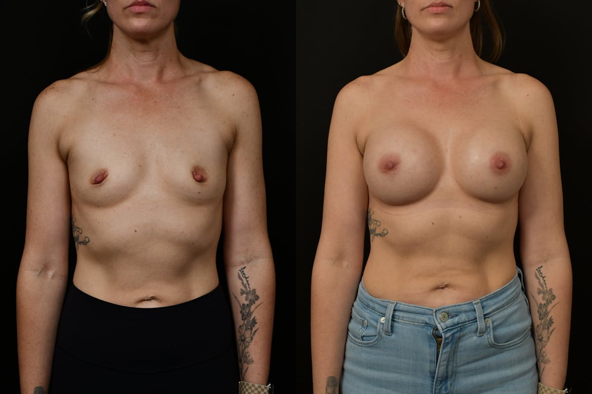 Breast Augmentation Before & After Gallery - Patient 217157 - Image 2