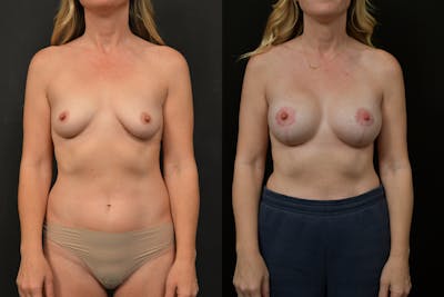 Reductive Augmentation Before & After Gallery - Patient 351479 - Image 1