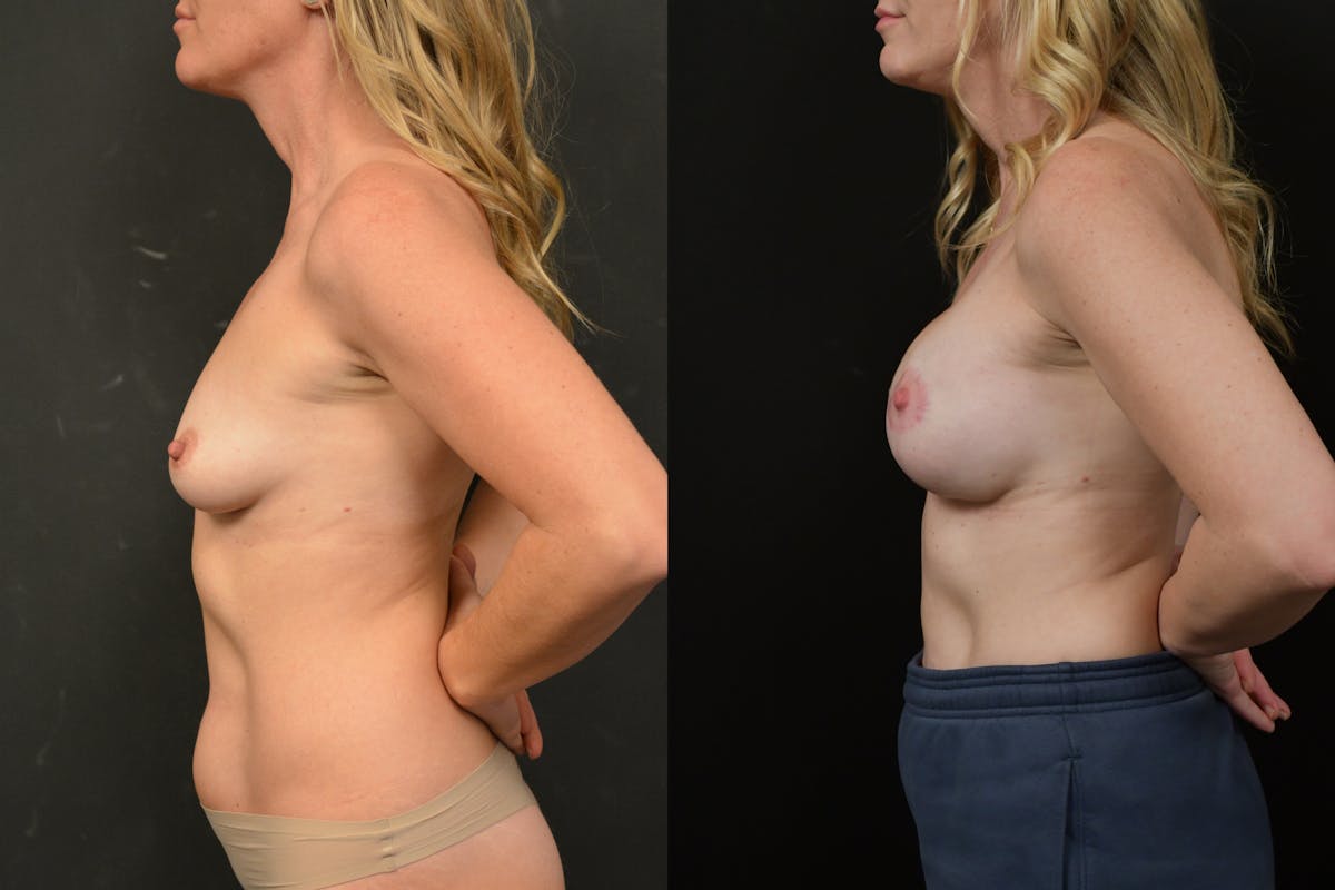 Reductive Augmentation Before & After Gallery - Patient 351479 - Image 6