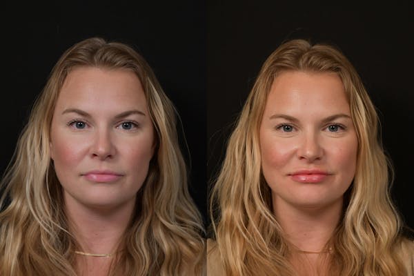 Lips Before & After Gallery - Patient 225753 - Image 1