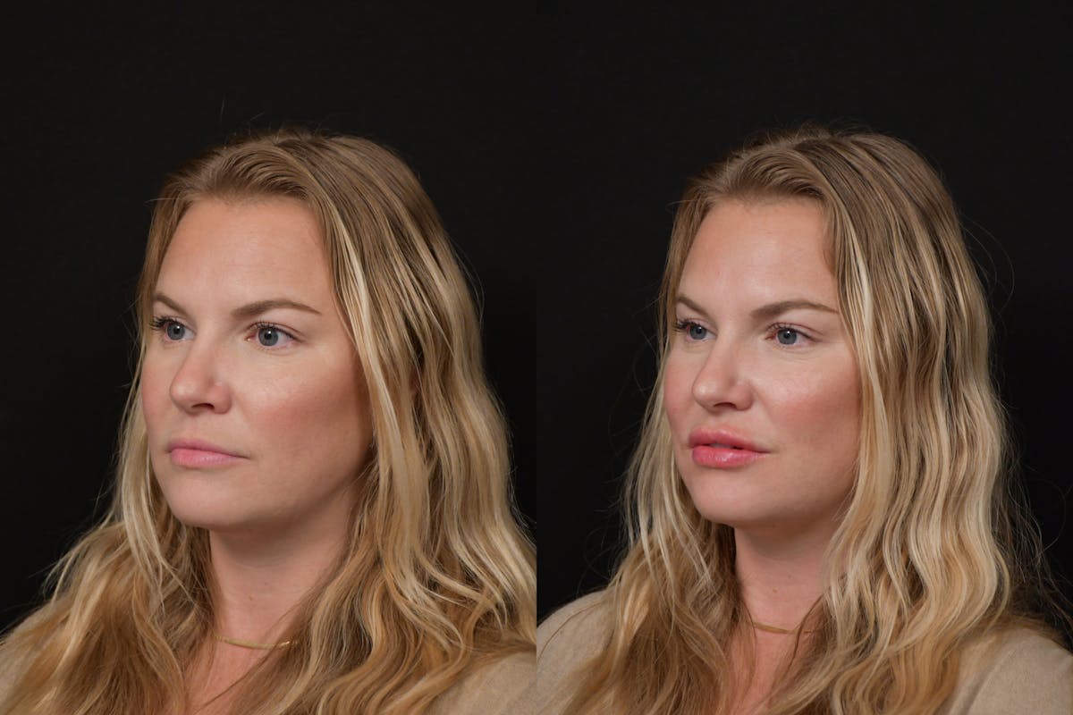 Lips Before & After Gallery - Patient 225753 - Image 4