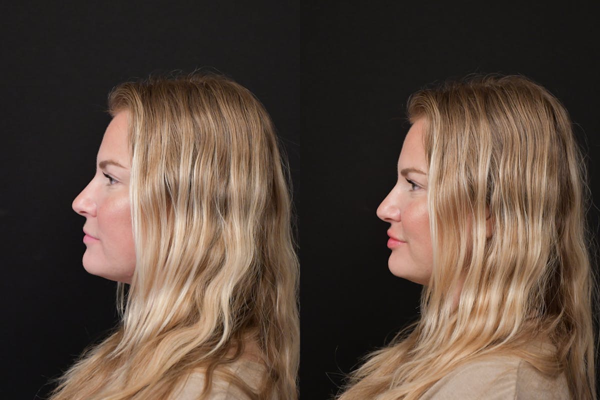 Lips Before & After Gallery - Patient 225753 - Image 5