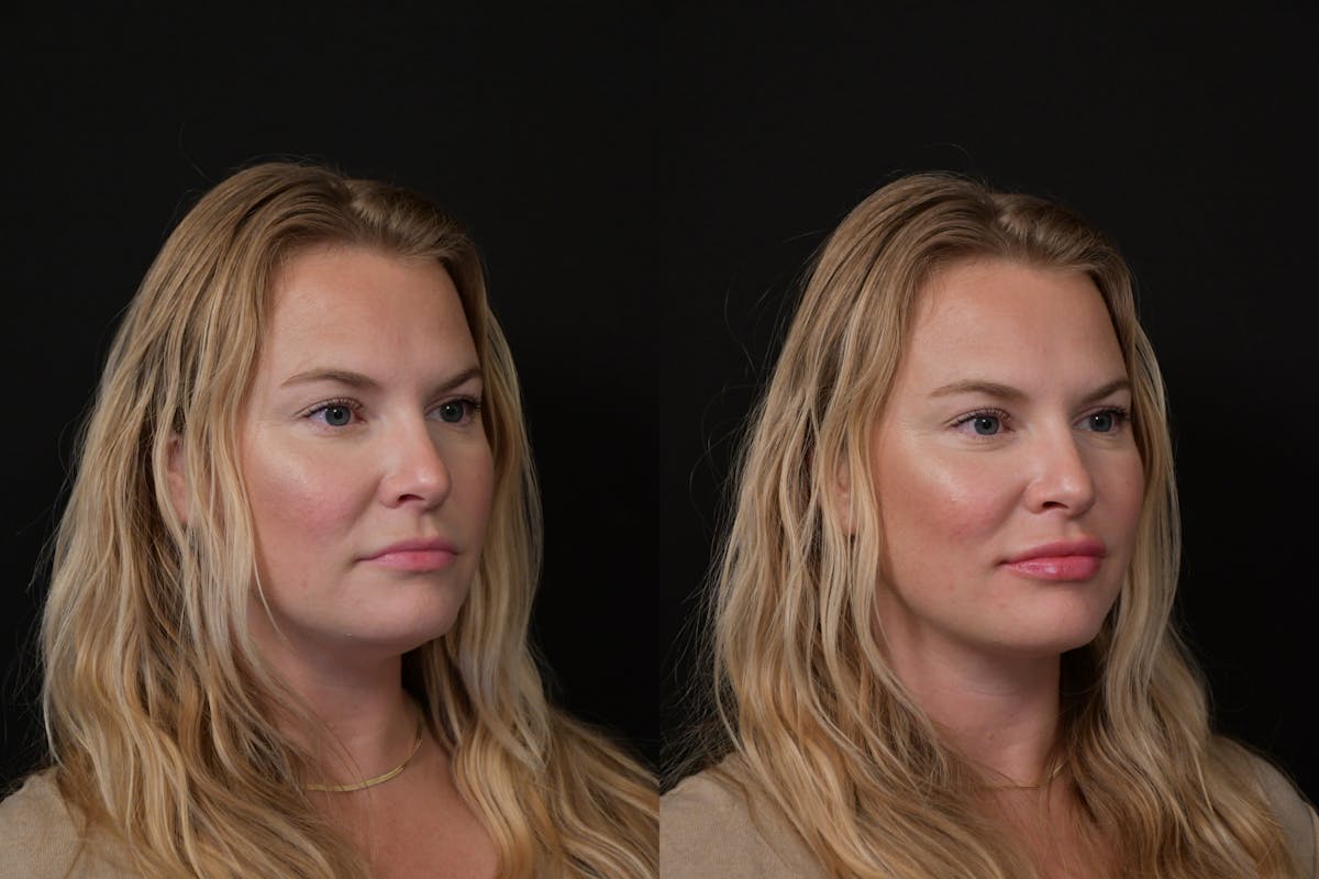 Lips Before & After Gallery - Patient 225753 - Image 2