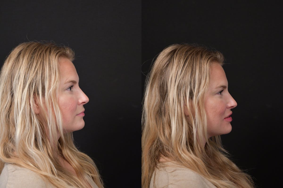 Lips Before & After Gallery - Patient 225753 - Image 3