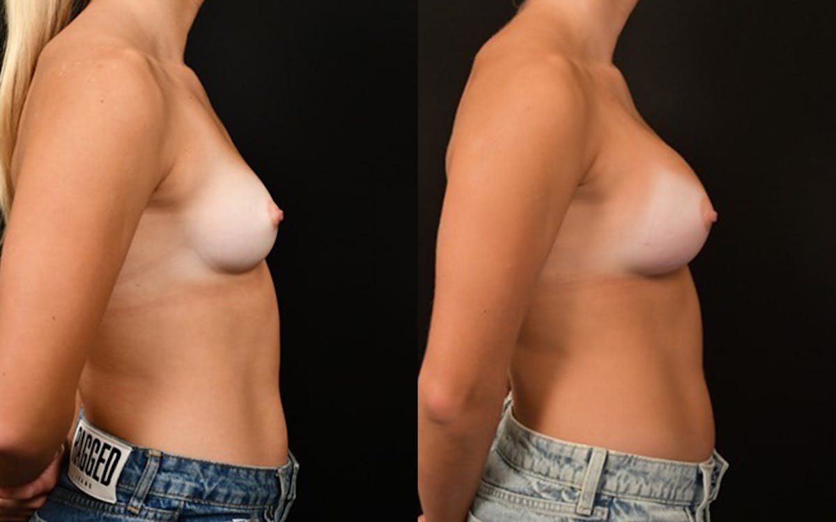 Breast Augmentation Before & After Gallery - Patient 393922 - Image 2