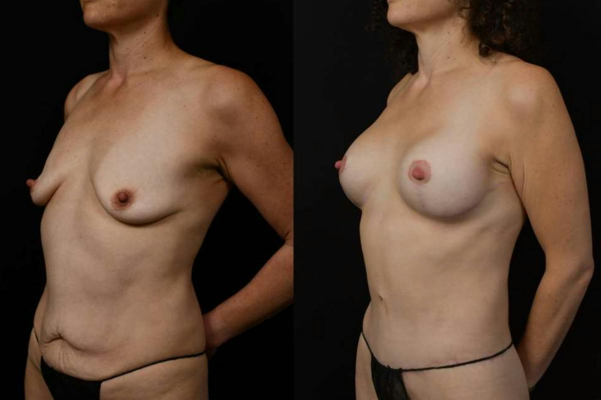 Mommy Makeover Before & After Gallery - Patient 247148 - Image 10