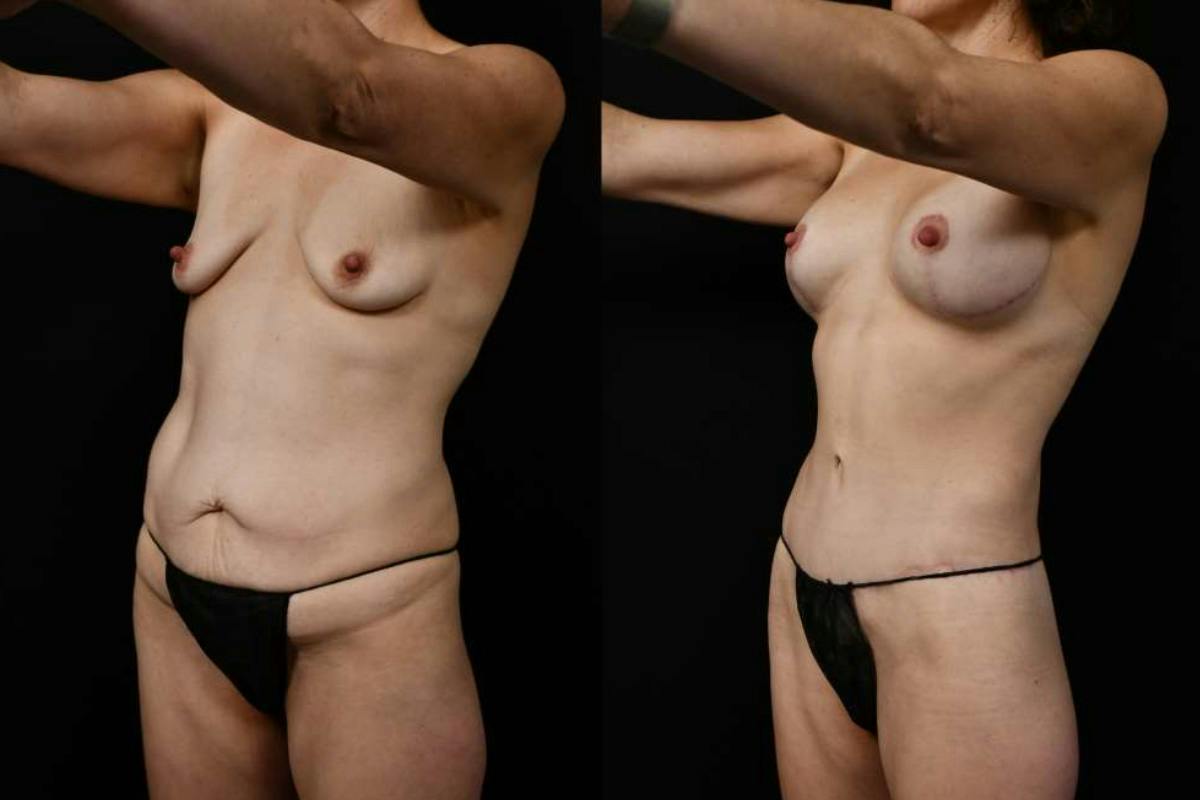 Mommy Makeover Before & After Gallery - Patient 247148 - Image 8