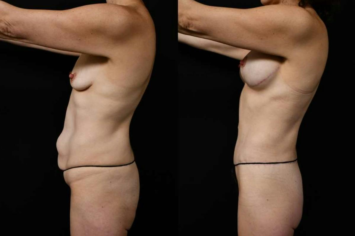 Mommy Makeover Before & After Gallery - Patient 247148 - Image 9