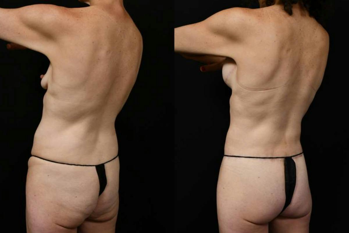 Mommy Makeover Before & After Gallery - Patient 247148 - Image 12