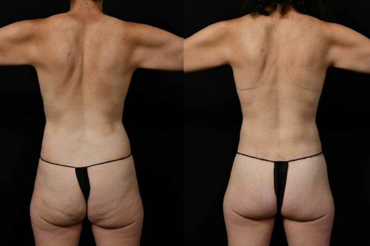 Mommy Makeover Before & After Gallery - Patient 247148 - Image 7