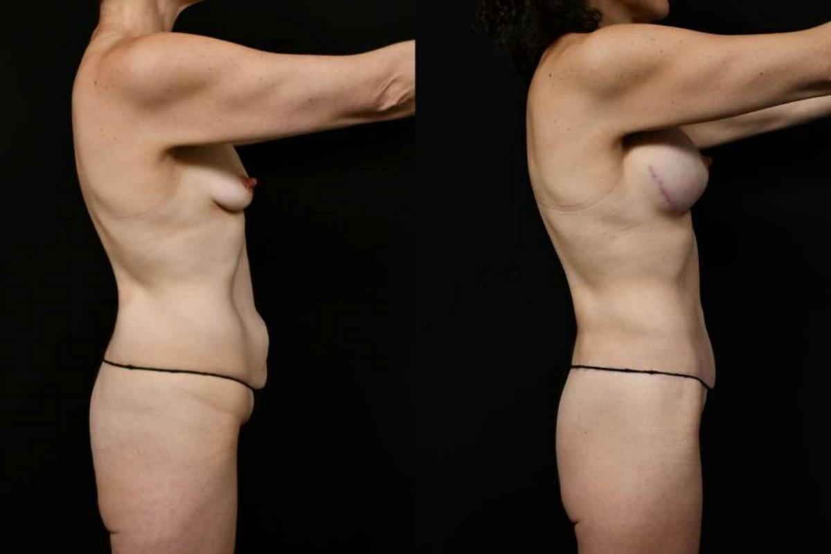 Mommy Makeover Before & After Gallery - Patient 247148 - Image 3
