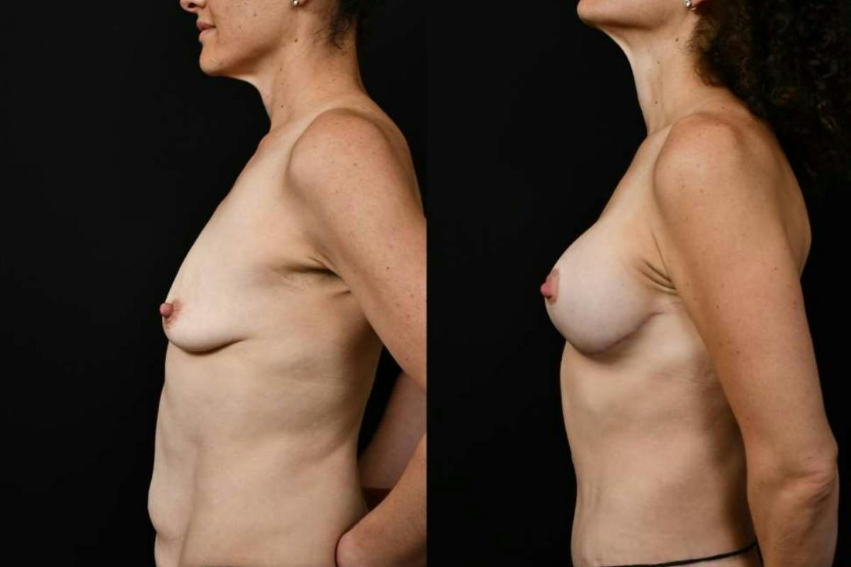 Mommy Makeover Before & After Gallery - Patient 247148 - Image 11