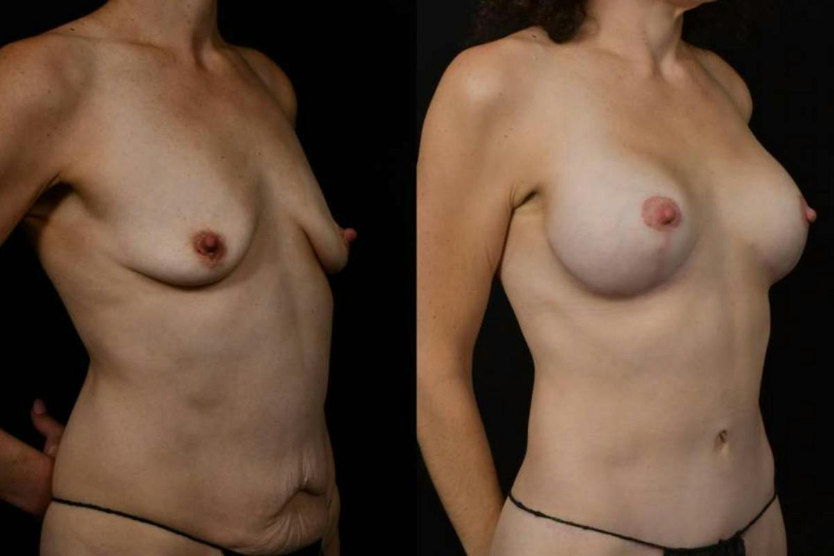 Mommy Makeover Before & After Gallery - Patient 247148 - Image 4