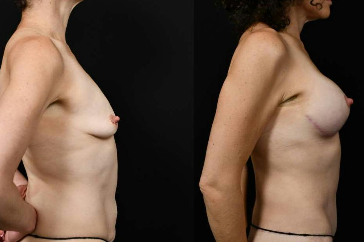 Mommy Makeover Before & After Gallery - Patient 247148 - Image 5