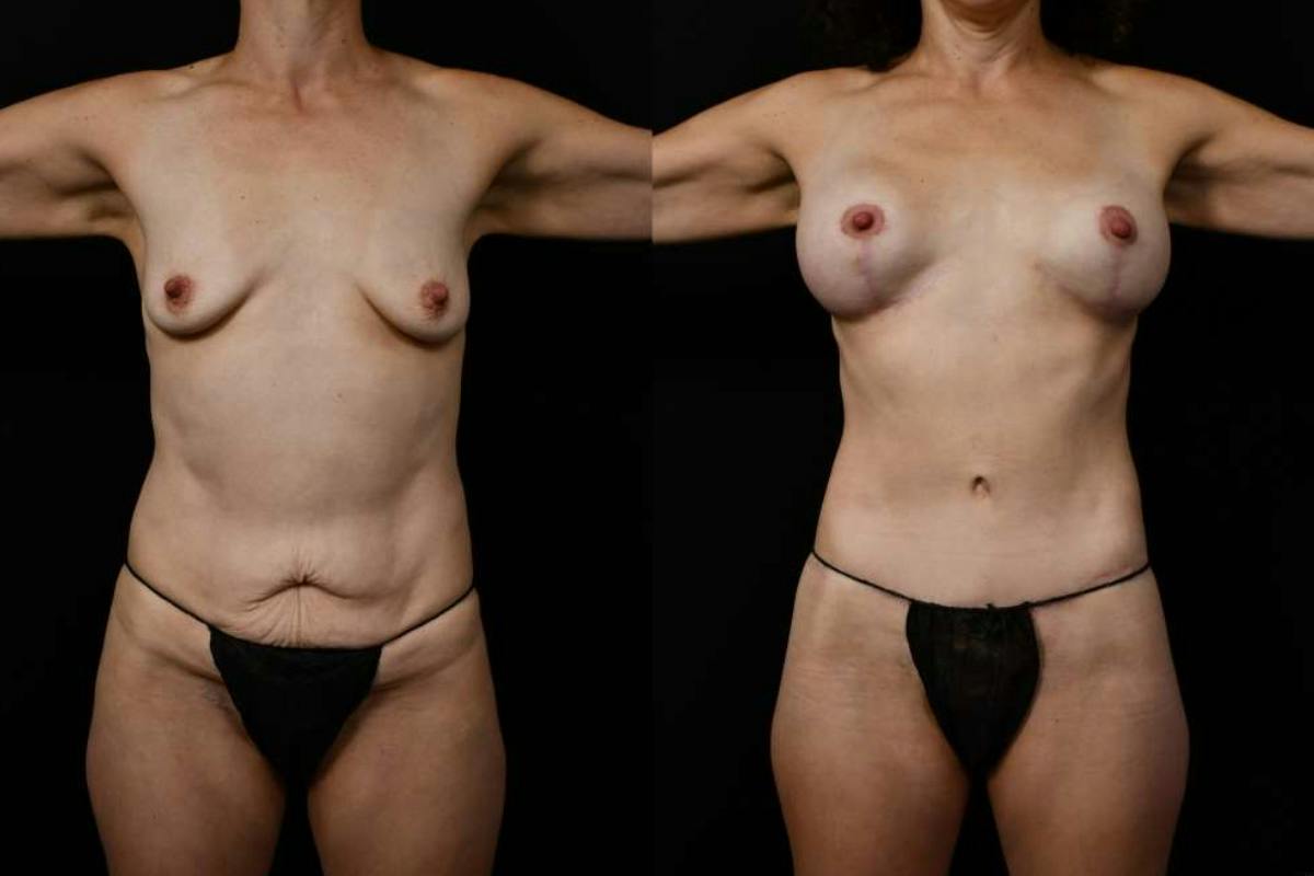 Mommy Makeover Before & After Gallery - Patient 247148 - Image 1