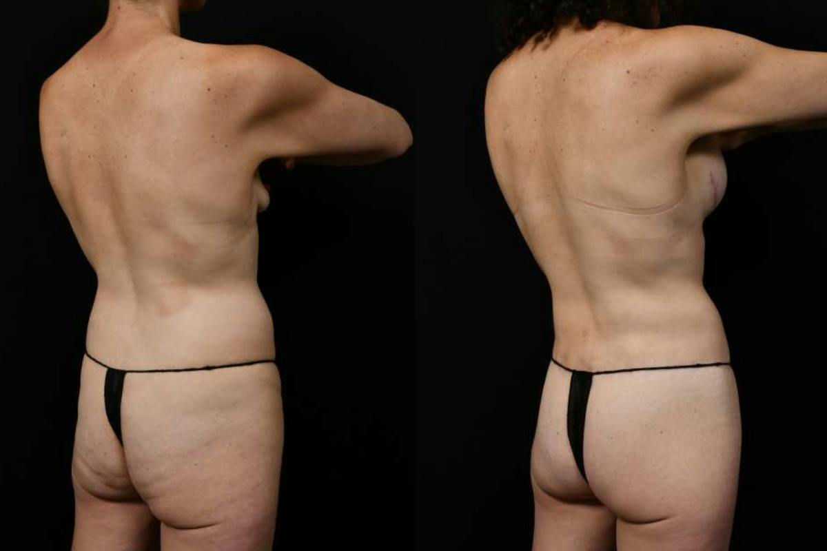 Mommy Makeover Before & After Gallery - Patient 247148 - Image 6