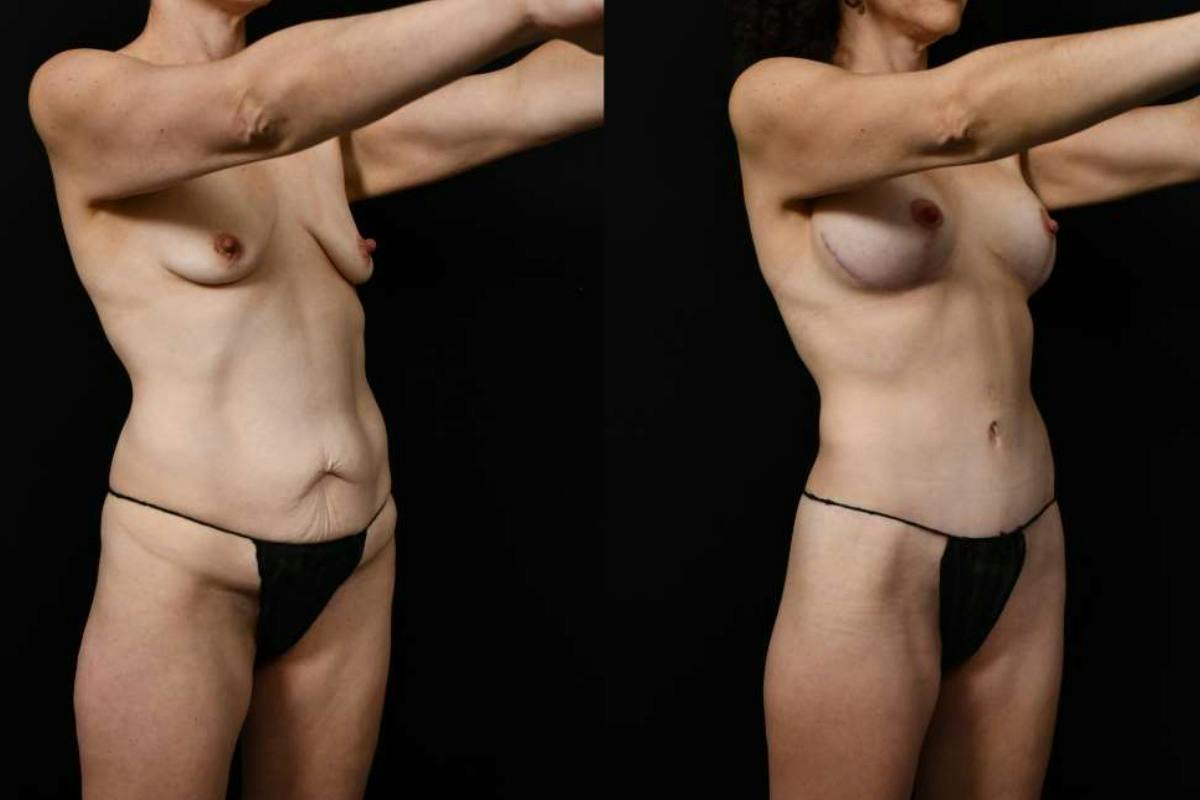 Mommy Makeover Before & After Gallery - Patient 247148 - Image 2
