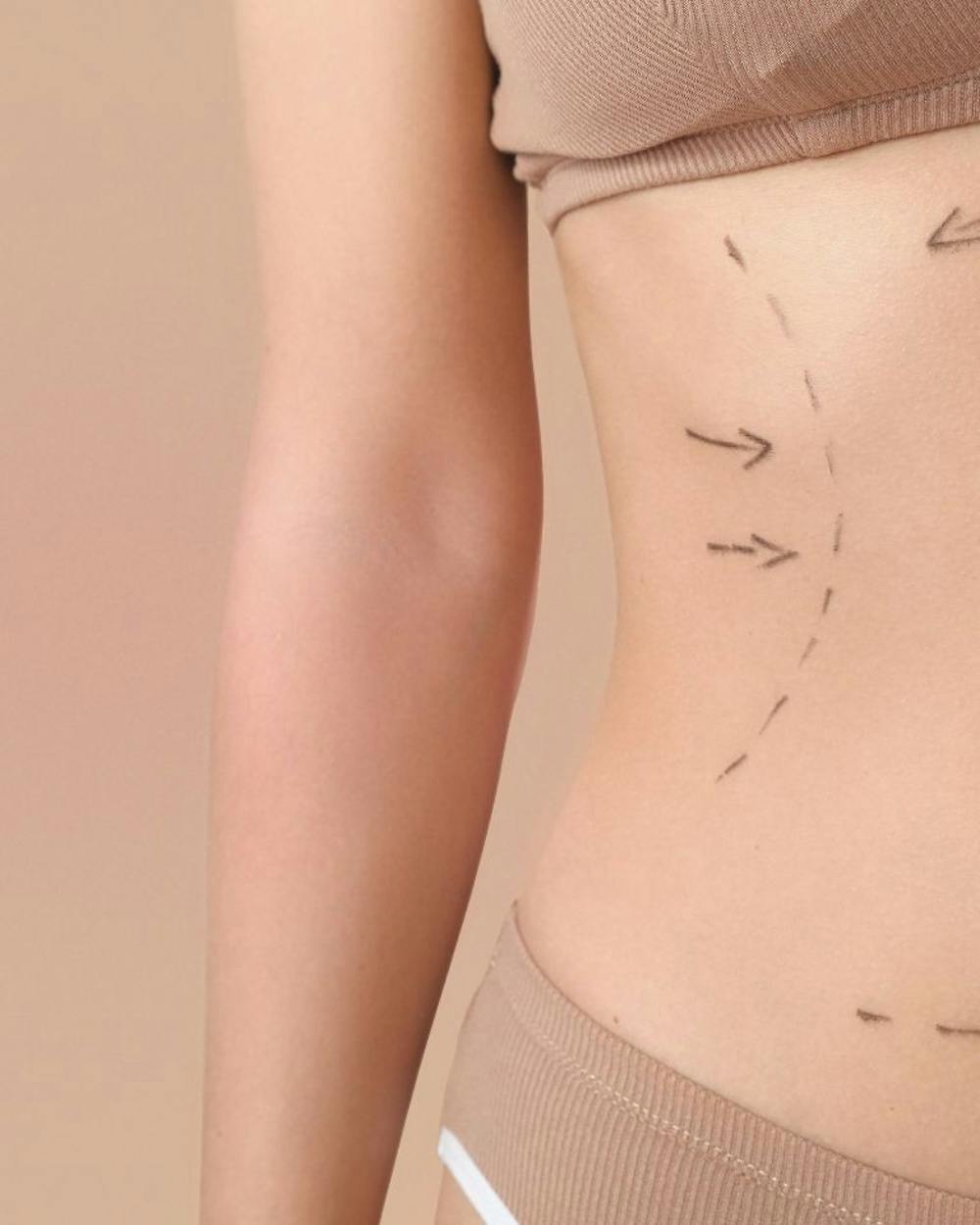 Body Lift After Weight Loss
