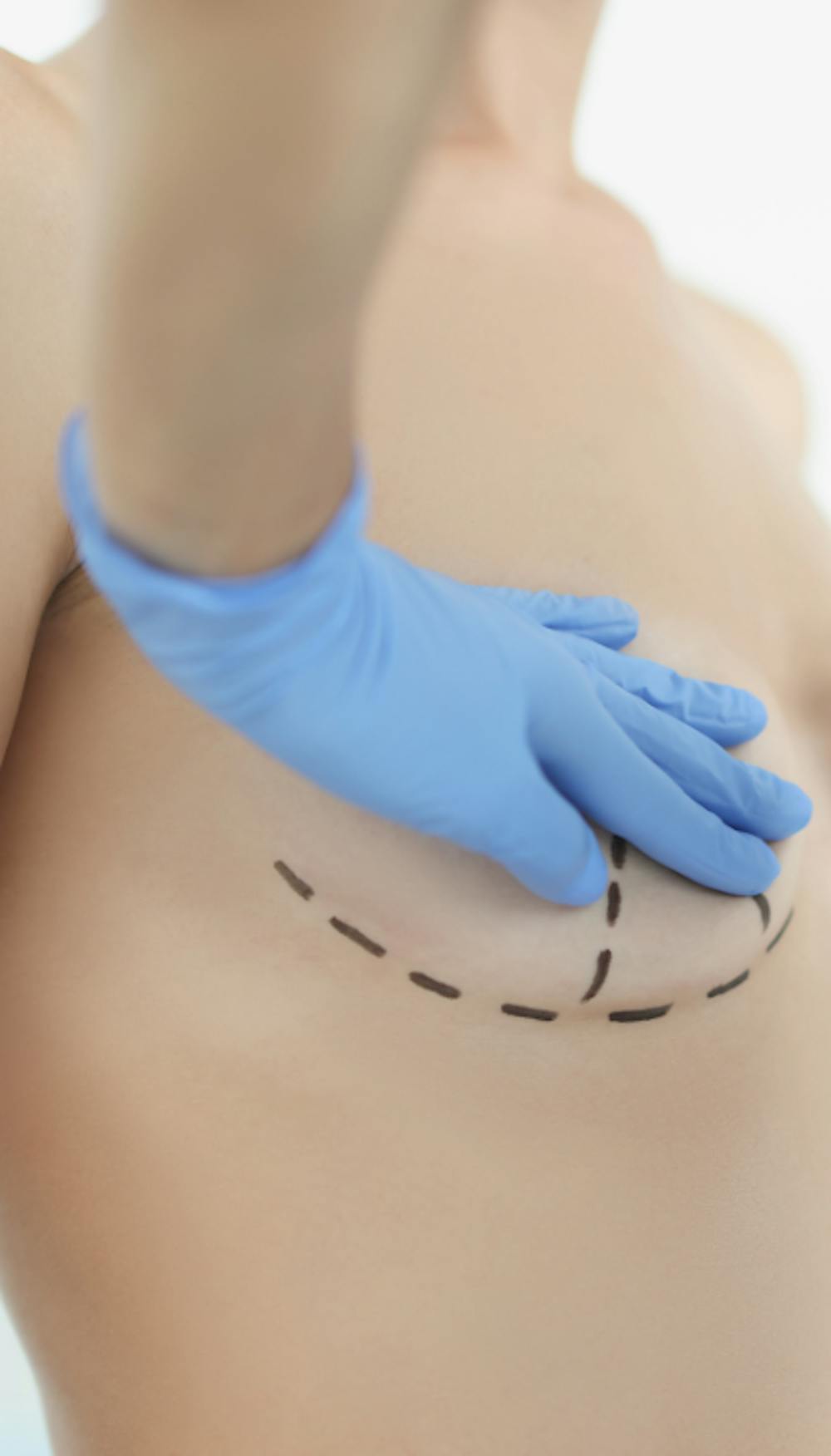 Where Can You Get The Best Breast Augmentation In Tampa