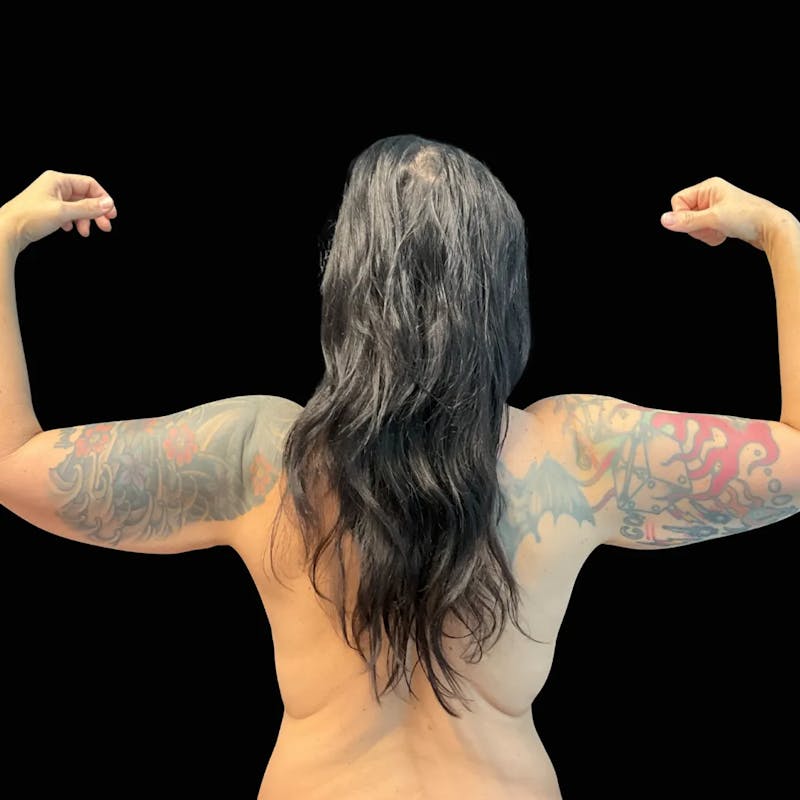 Arm Lift Before & After Gallery - Patient 151306 - Image 1