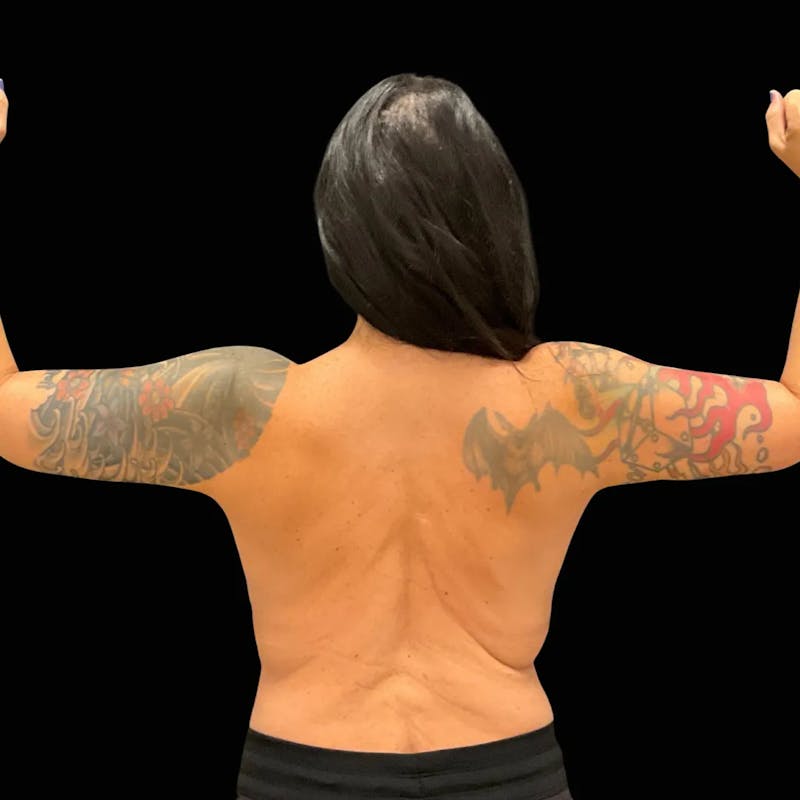 Arm Lift Before & After Gallery - Patient 151306 - Image 2