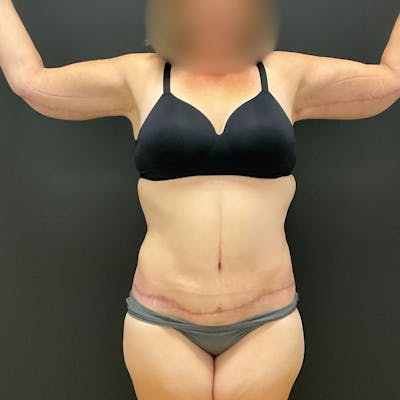 Arm Lift Before & After Gallery - Patient 360159 - Image 2