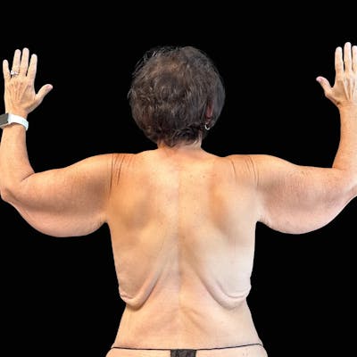 Arm Lift Before & After Gallery - Patient 417570 - Image 1