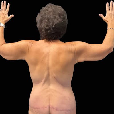 Arm Lift Before & After Gallery - Patient 417570 - Image 2