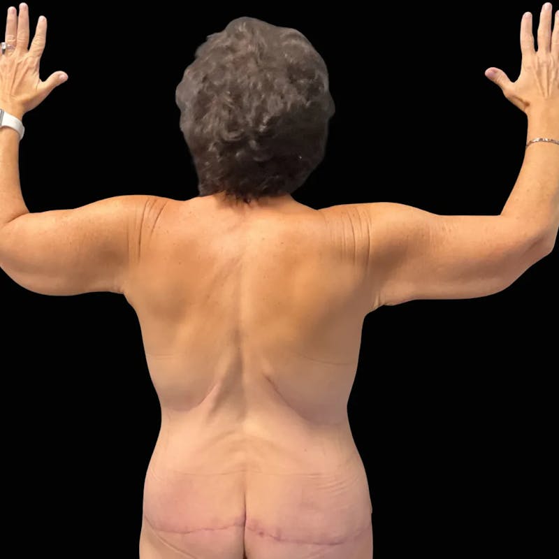 Arm Lift Before & After Gallery - Patient 417570 - Image 2