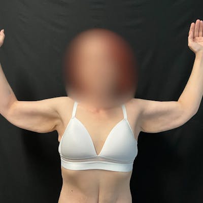 Arm Lift Before & After Gallery - Patient 264250 - Image 1