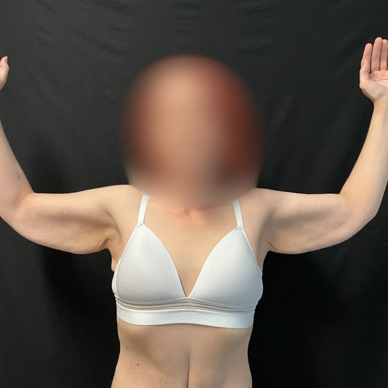 Arm Lift Before & After Gallery - Patient 264250 - Image 1