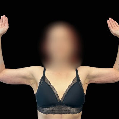 Arm Lift Before & After Gallery - Patient 264250 - Image 2