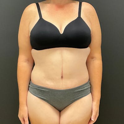 Body Lift Before & After Gallery - Patient 710112 - Image 2