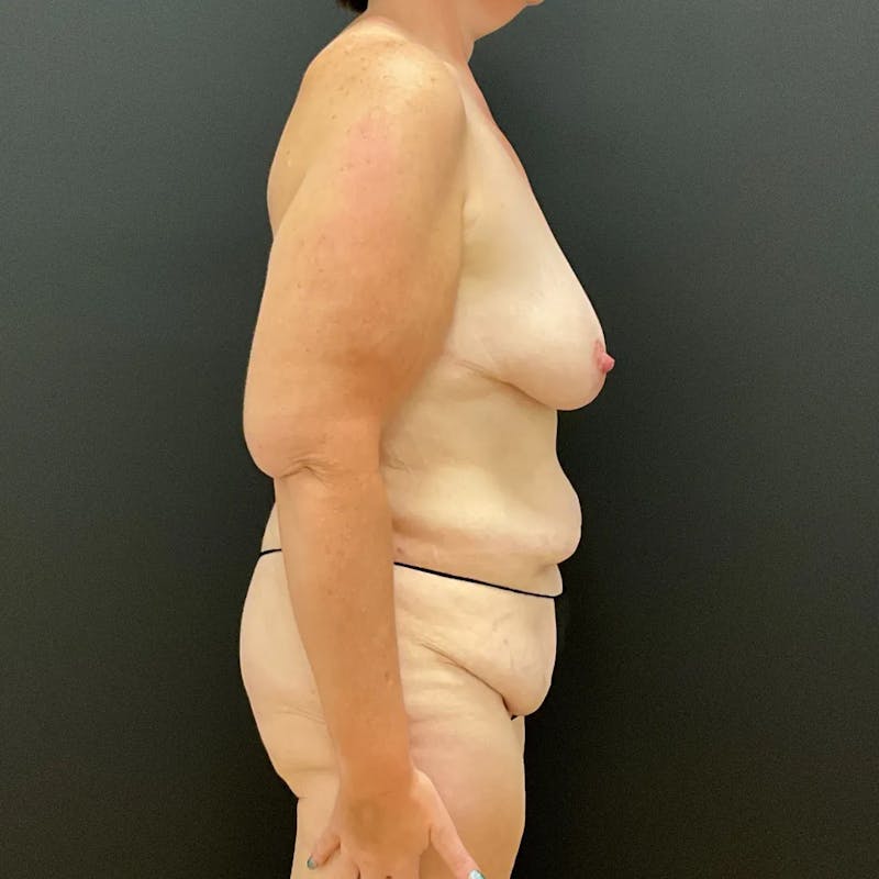 Body Lift Before & After Gallery - Patient 710112 - Image 3