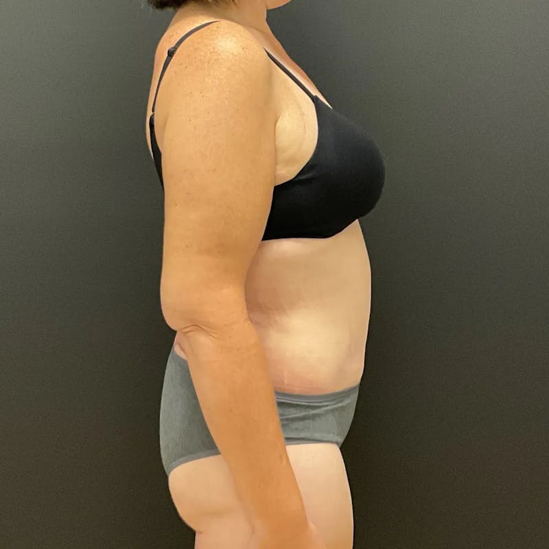 Body Lift Before & After Gallery - Patient 710112 - Image 4
