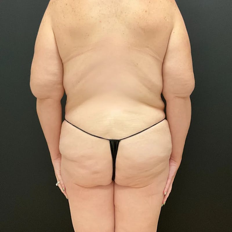 Body Lift Before & After Gallery - Patient 710112 - Image 5