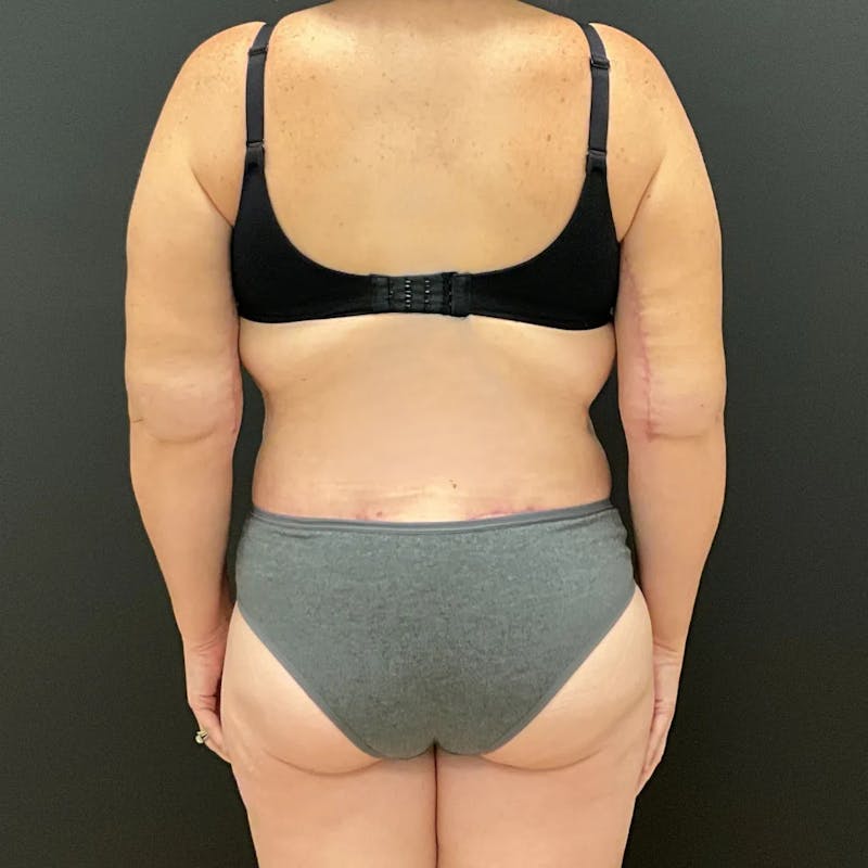 Body Lift Before & After Gallery - Patient 710112 - Image 6