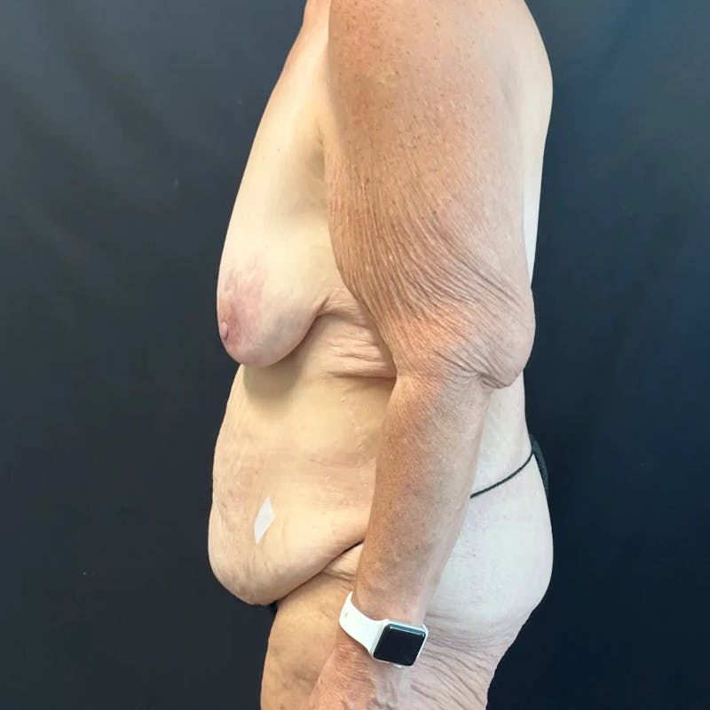 Body Lift Before & After Gallery - Patient 163978 - Image 3