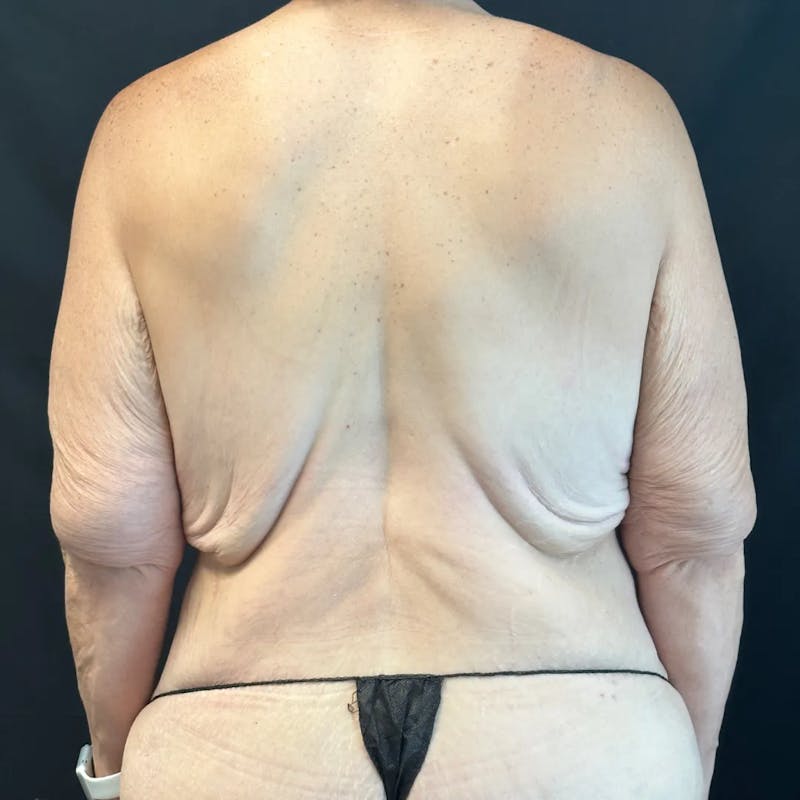 Body Lift Before & After Gallery - Patient 163978 - Image 5