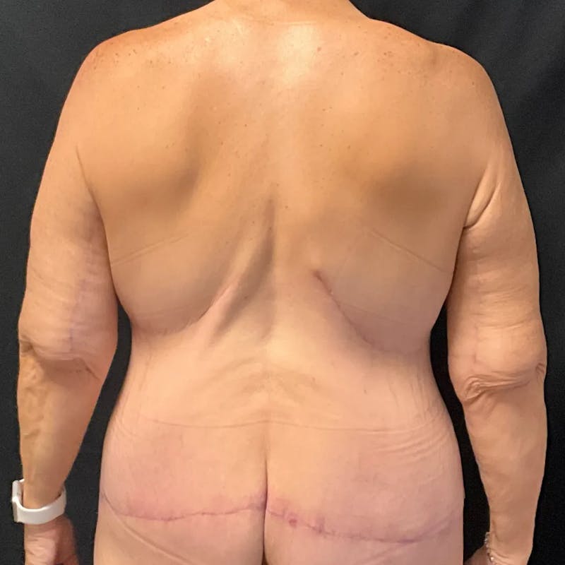 Body Lift Before & After Gallery - Patient 163978 - Image 6