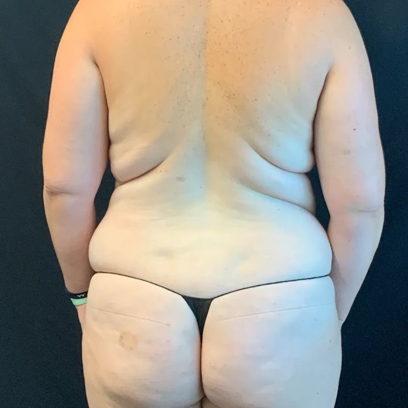 Body Lift Before & After Gallery - Patient 389534 - Image 5
