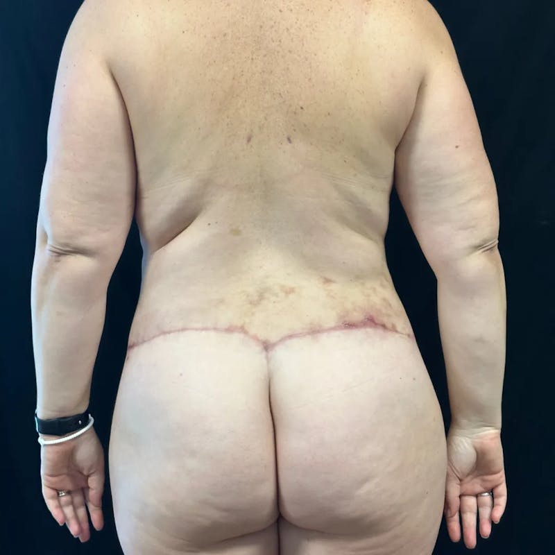 Body Lift Before & After Gallery - Patient 389534 - Image 6