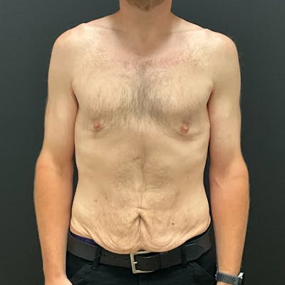 Body Lift Before & After Gallery - Patient 393208 - Image 1