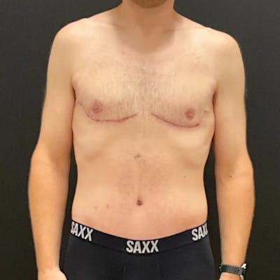 Body Lift Before & After Gallery - Patient 393208 - Image 2