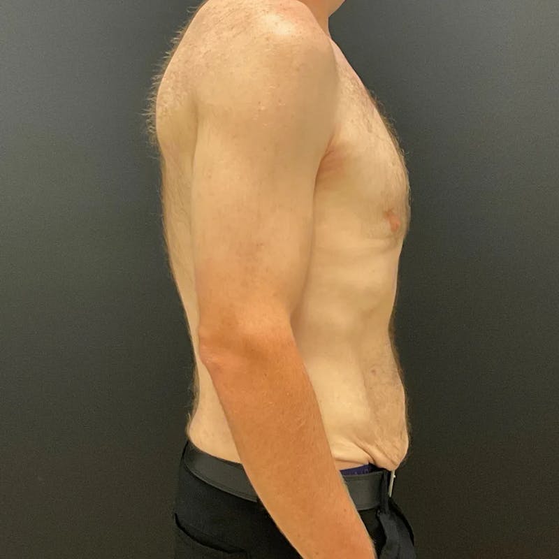 Body Lift Before & After Gallery - Patient 393208 - Image 3
